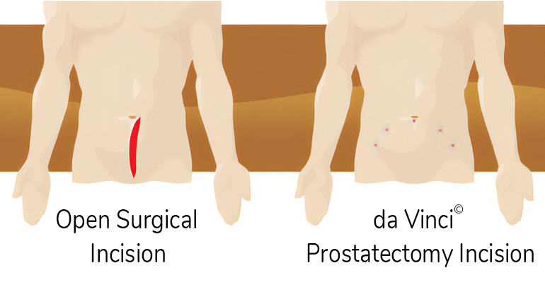 surgical incision vs prostatectomy comparison