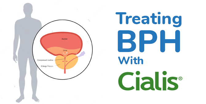 Treating BPH with Cialis